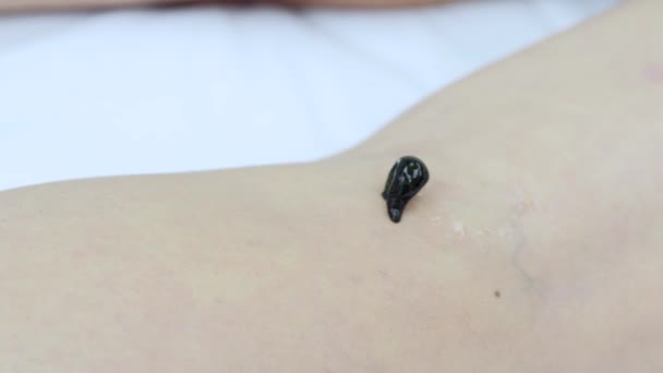 Hirudothérapie en clinique - Sangsue sur la peau de la femme 
