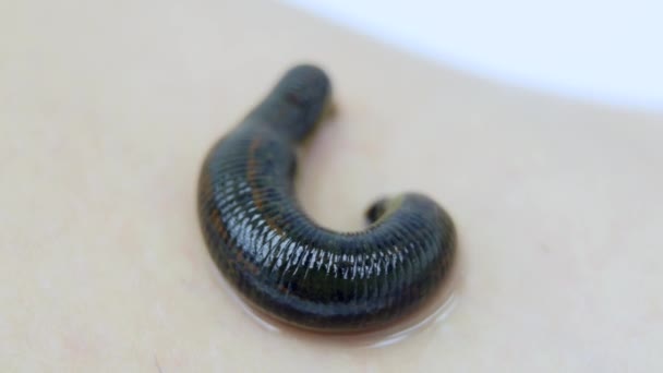 Hirudotherapy in clinic - Leech on skin of woman — Stock Video