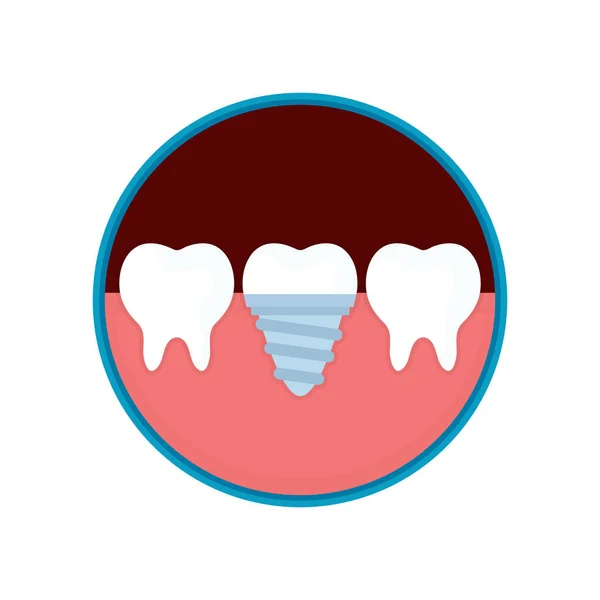 Dental implant in mond met vervanging — Stockvector