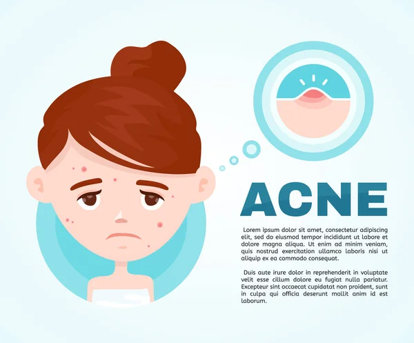 Infografía del acné. Vector de estilo plano moderno — Archivo Imágenes Vectoriales