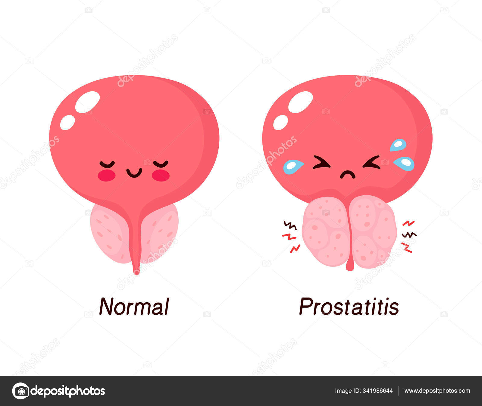 Proteus mirabilis prostatitis anális szex