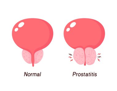Normal prostat ve iyi huylu protez hiperplazi.