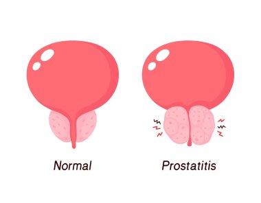 Normal prostate and benign prostatic hyperplasia clipart