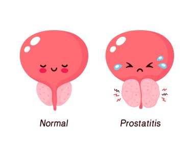 Normal prostate and benign prostatic hyperplasia clipart