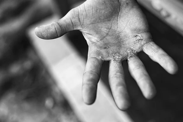 Palma con callos. Concepto de trabajo duro. Ampollas en la mano lesionada del trabajo manual . —  Fotos de Stock