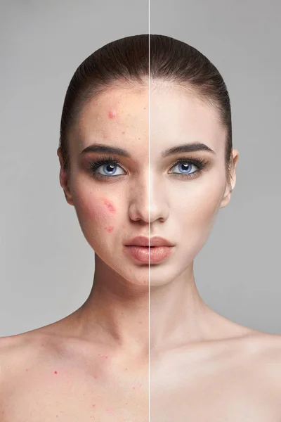 Pryszcze i trądzik na twarzy kobiety przed i po. Kosmetyki do usunąć pryszcze i zaskórniki. Skóry naturalne skóry naturalne. Piękna kobieta twarz zbliżenie, Dermatologia. — Zdjęcie stockowe