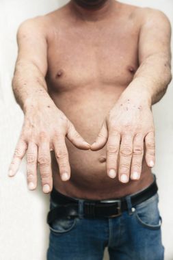 Kuru ve kaşıntılı cilt sorunu olan adam