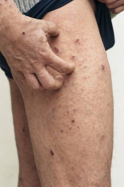 Kuru ve kaşıntılı cilt sorunu olan adam