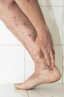 Kuru ve kaşıntılı cilt sorunu olan adam