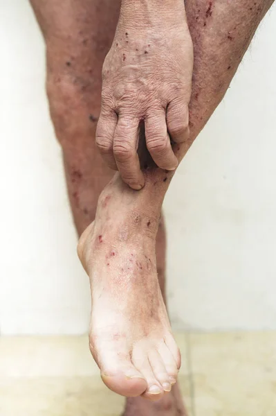 Hombre que tiene picazón y problemas de piel seca — Foto de Stock