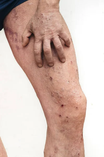 Hombre que tiene picazón y problemas de piel seca — Foto de Stock