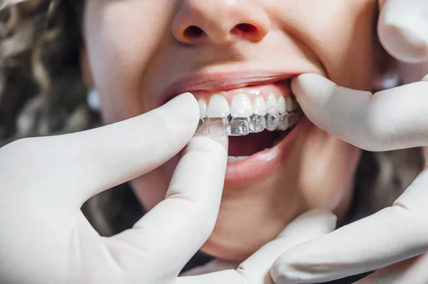 Doctor poniendo un alineador dental claro a la mujer paciente —  Fotos de Stock