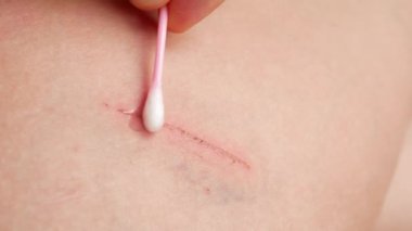 Bir yara dezenfektan