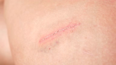 Temizlik lezyon veya alkolle dezenfekte için deride yara