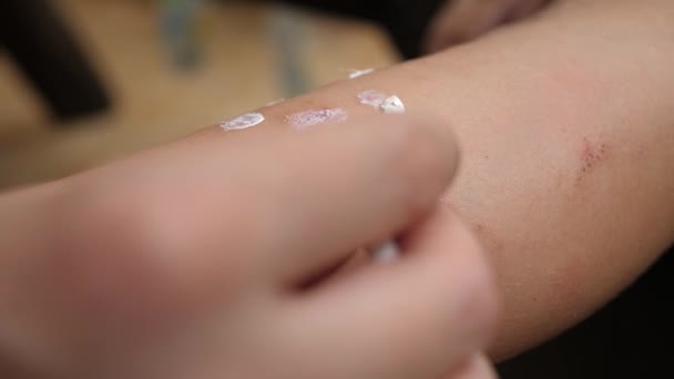 Moeder veroorzaakt medische therapeutische zalf op dochters been huid — Stockvideo