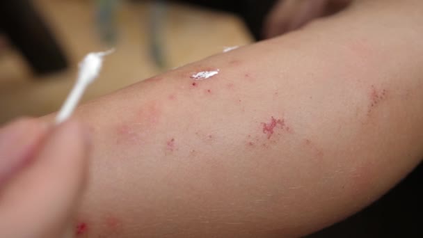 Female hand rubs curative ointment in wound on skin leg — 图库视频影像