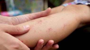 Mosquito bite damages on leg skin of little child girl