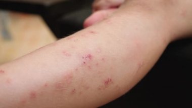 Disinfection of wound on childs leg skin