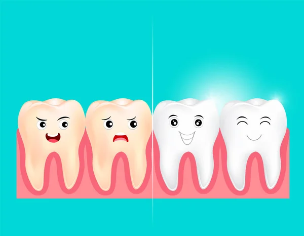 Folheados dentários num dente humano. Antes e depois . —  Vetores de Stock