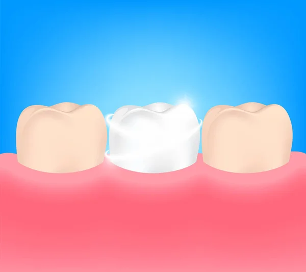 Dental veneers on a human tooth.  Before and After. — Stock Vector