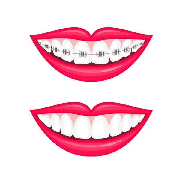 Dientes perfectos antes y después de los aparatos ortopédicos . — Vector de stock