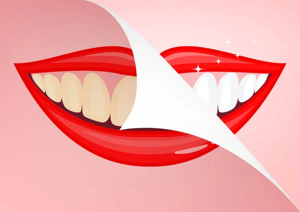 Menschlicher Mund mit weißen Zähnen, davor und danach. — Stockvektor