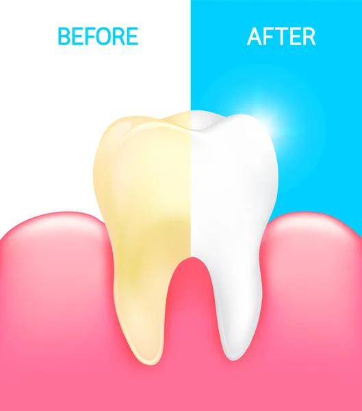 Impiallacciatura dentale, dente prima e dopo . — Vettoriale Stock