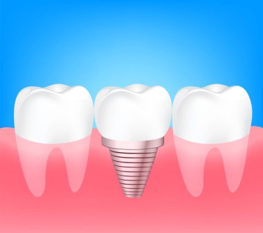 İki sağlıklı dişler ve implant diş arasında.