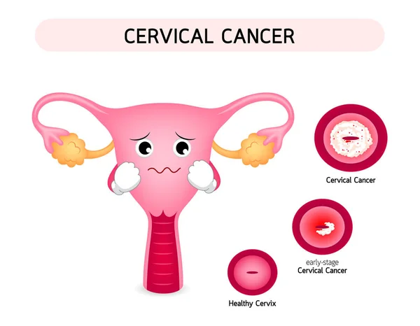 Cervicale diagramma cancro con tristezza personaggio cartone animato utero . — Vettoriale Stock