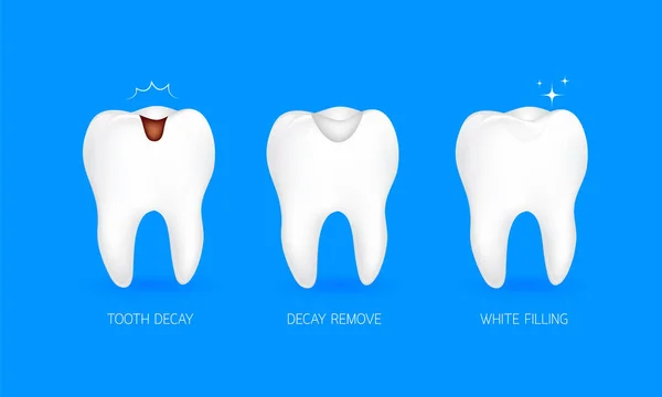 Krok zubní výplně. Zubní kaz, kaz odebrat a bílá náplň. — Stockový vektor