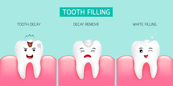 Passo de enchimento dentário. Decadência dentária, remoção de decaimento e enchimento branco . —  Vetores de Stock