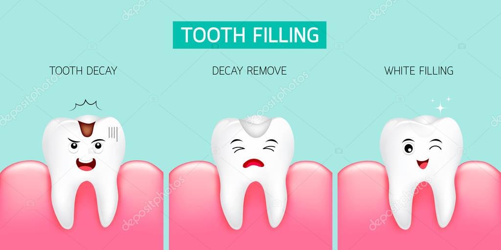 Paso de relleno dental. Caries dental, caries y relleno blanco. 2024