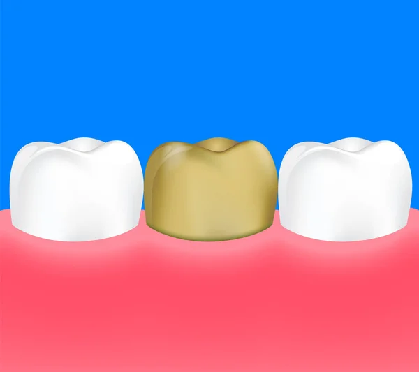 Goldzahn zwischen gesunden Zähnen. Metallkronen, — Stockvektor