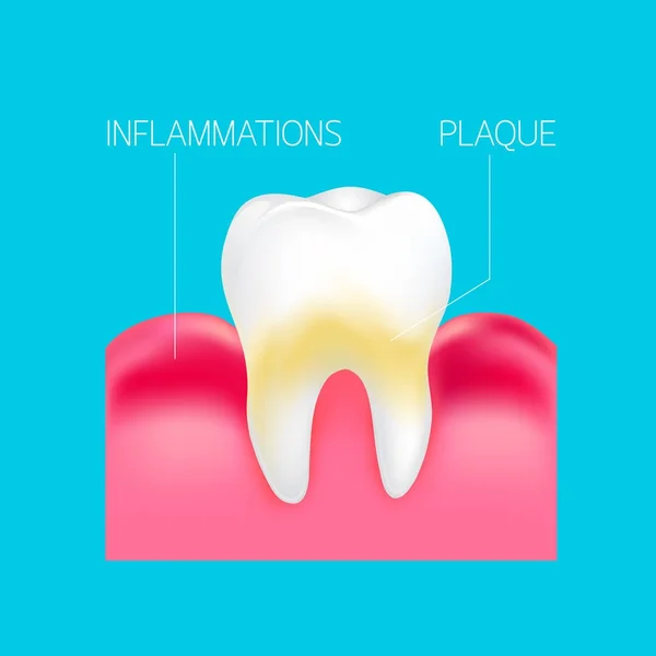 Plaque et inflammations gomme sur dent humaine info-graphique . — Image vectorielle