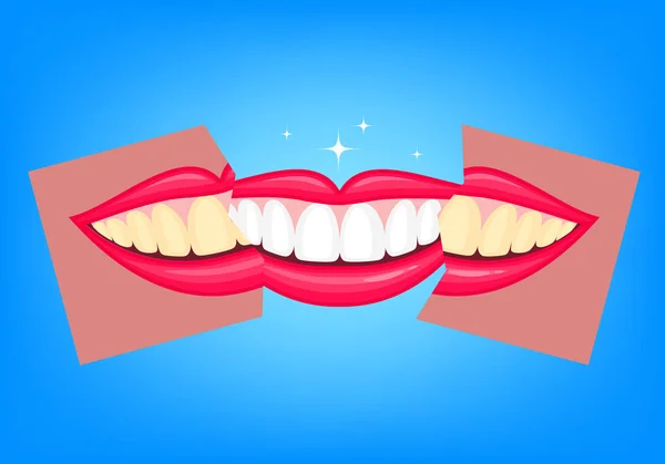 Відбілювання зубів, до і після . — стоковий вектор