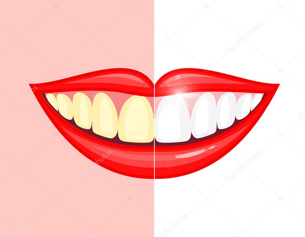 bleaching teeth treatment. Whiten teeth before and after. Vector illustration isolated on pink and white background. Dental care concept.
