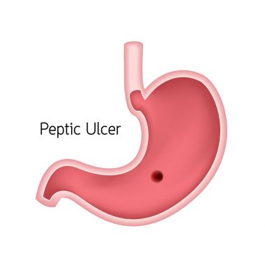 İnsan mide kesiti. Peptik ülser, insan heath bakım. Beyaz arka plan üzerinde izole vektör çizim