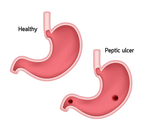 Comparaison Estomac Santé Ulcère Hygiène Gastrique Humaine Illustration Vectorielle Isolée — Image vectorielle