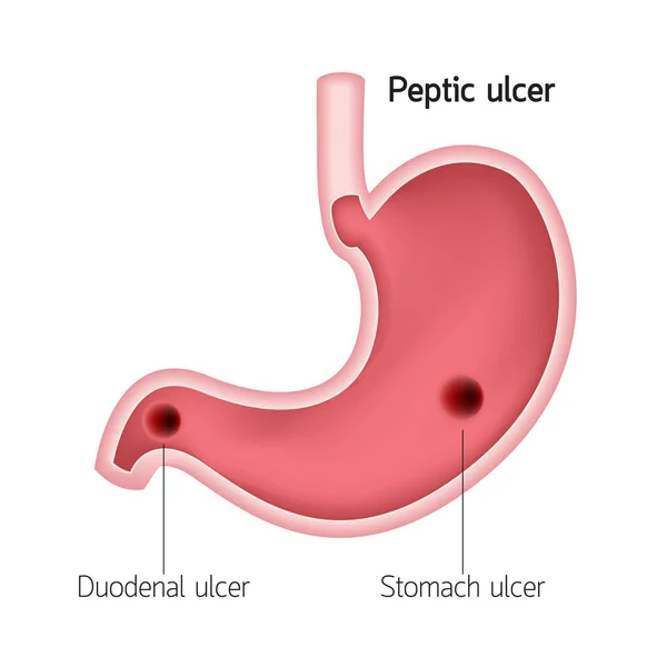 Sezione Trasversale Dello Stomaco Umano Ulcera Peptica Cure Mediche Umane — Vettoriale Stock