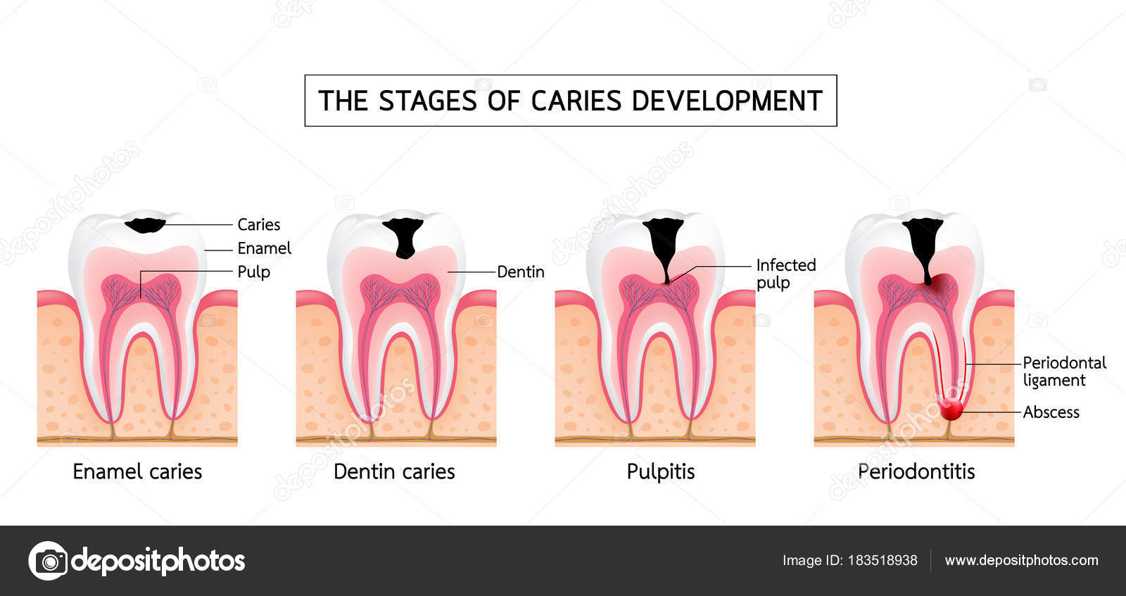 Estágios Desenvolvimento Cárie Cárie Esmalte Cárie Dentinária Pulpite