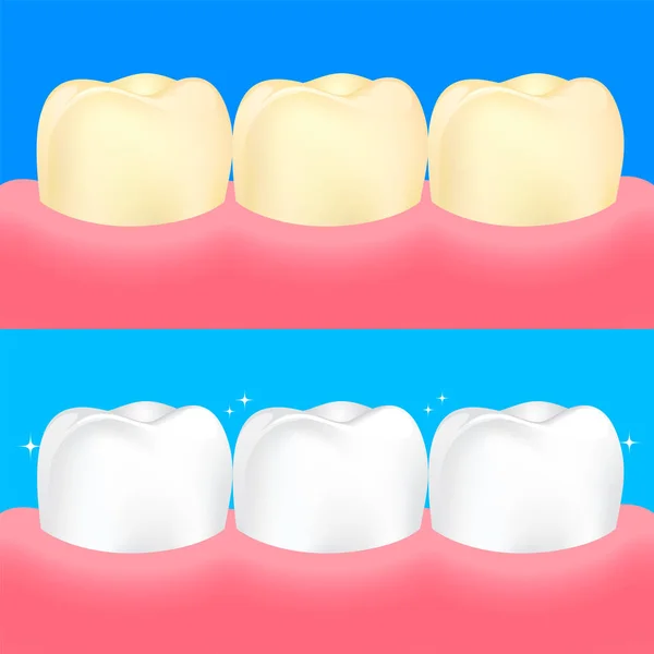 Veneers Auf Menschlichen Zahn Vor Und Nach Der Zahnaufhellung Tiefenreinigung — Stockvektor