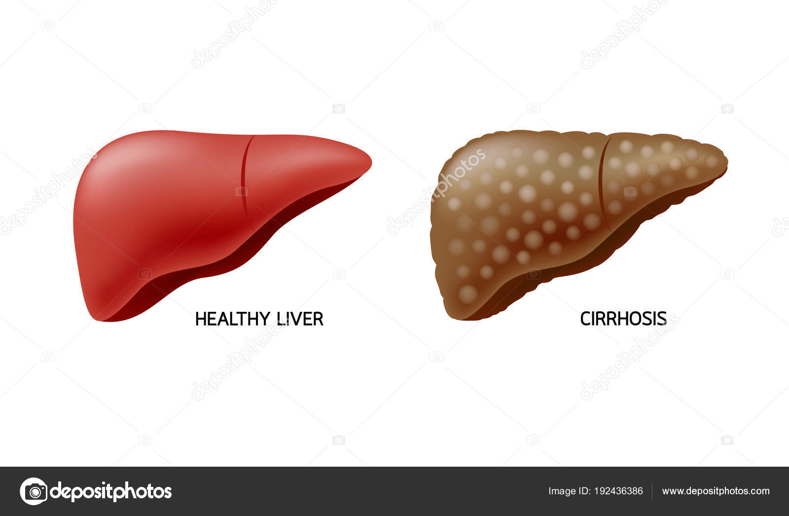 Que es la enfermedad de la cirrosis