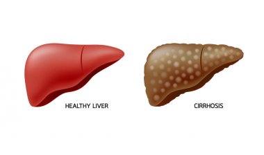 Comparison of healthy liver and cirrhosis. Liver Disease. Illustration info-graphic, isolated on white background. clipart