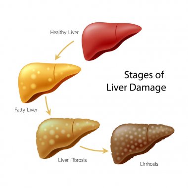 Stages of liver damage. Liver Disease. Healthy, fatty, fibrosis and Cirrhosis. Illustration info-graphic, isolated on white background. clipart