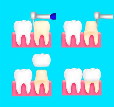 Diş crown yükleme işlemi. Diş Bakımı kavramı. İllüstrasyon izole mavi arka plan üzerinde.