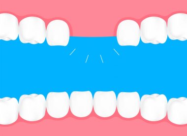 İnsan kaybeden dişler ağızda. Bilgi grafik, diş bakım kavramı. İllüstrasyon izole mavi arka plan üzerinde.