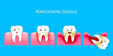 Periodontal hastalık adım. Sağlıklı diş ve dişeti iltihabı. Diş Bakımı kavramı. İllüstrasyon izole mavi arka plan üzerinde.