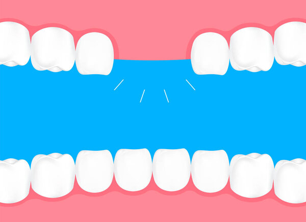 Human losing teeth in mouth. Info-graphic, dental care concept. Illustration isolated on blue background.