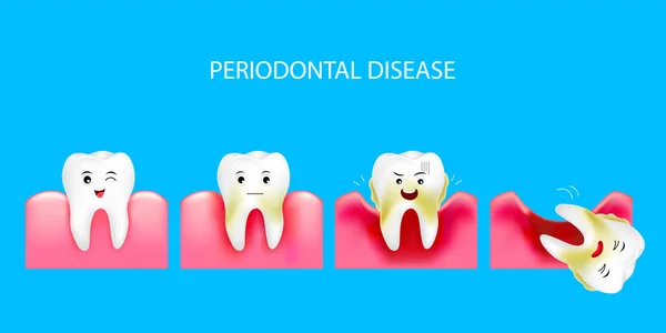 Periodontal hastalık adım. Sağlıklı diş ve dişeti iltihabı. Diş Bakımı kavramı. İllüstrasyon izole mavi arka plan üzerinde.