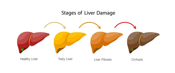 Fasi Danno Epatico Malattia Epatica Sano Grasso Fibrosi Cirrosi Info — Vettoriale Stock